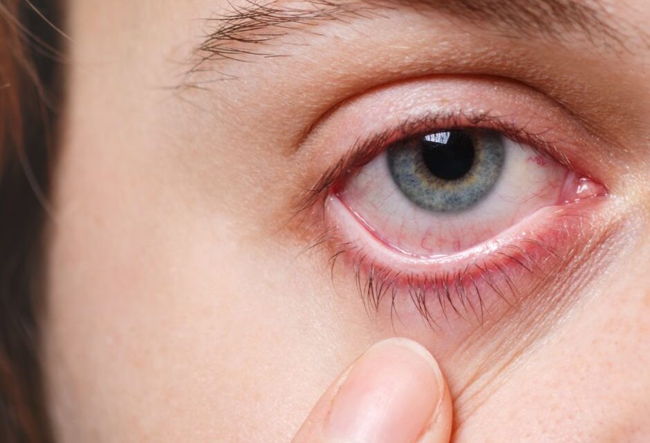 Blepharitis May Be The Cause of Crusty Eyelids Or Eyelashes